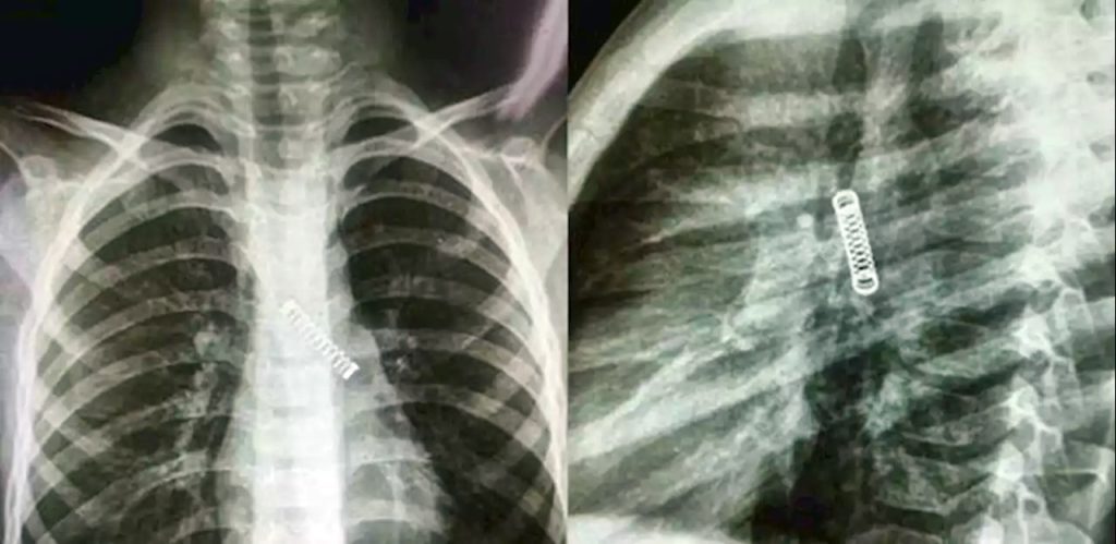 Menino sofre de tosse constante e médicos acham mola de metal no pulmão 1 Reprodução