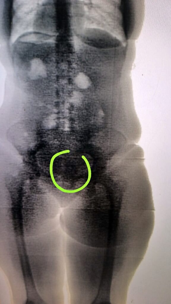 mulher que tentou entrar com droga em presídio