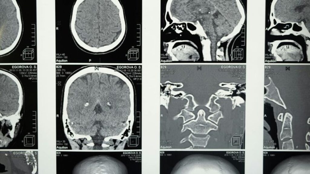 Implante cerebral faz pessoa com paralisia voltar a falar 2 idiomas