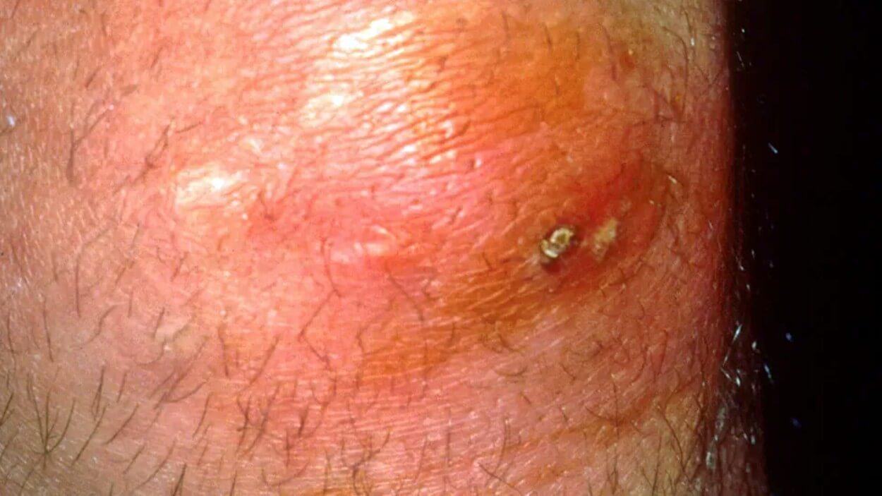Furúnculo pode matar? Dermatologista alerta sobre riscos