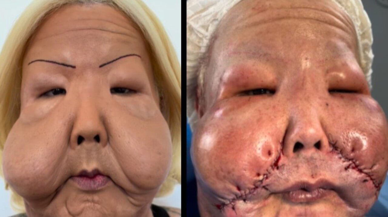 Influenciadora que teve o rosto deformado após procedimento estético em uma clínica clandestina passa por cirurgia